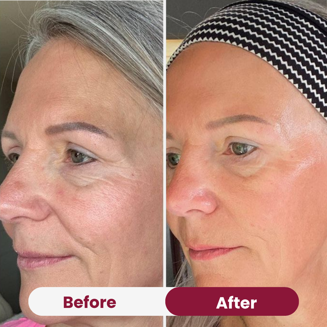 Bio-Collagen Mask before and after