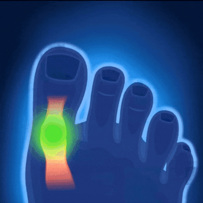 Invisible bunion corrector demonstration